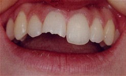 Closeup of a chipped tooth