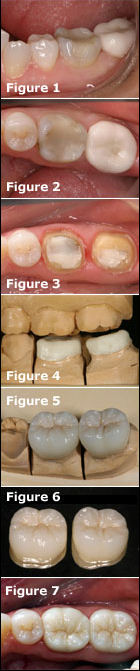 Adhesive Esthetic Dentistry