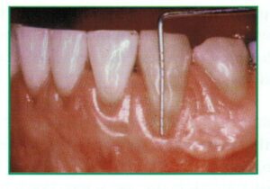 Clode up of a gum line experiencing periodontal disease