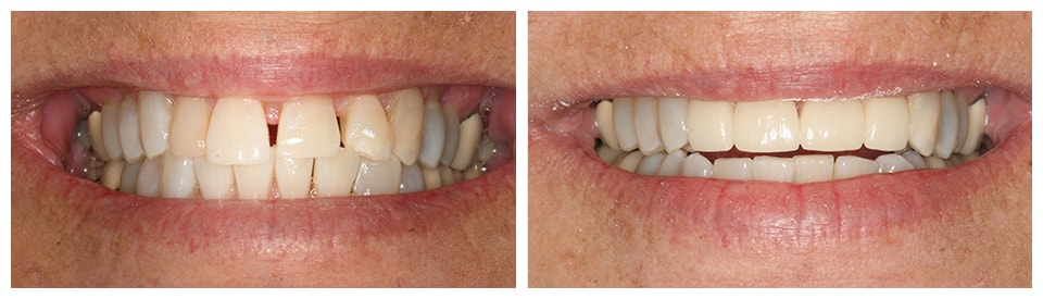 Two pictures of patient's teeth before and after Dr. Larrondo did his magic